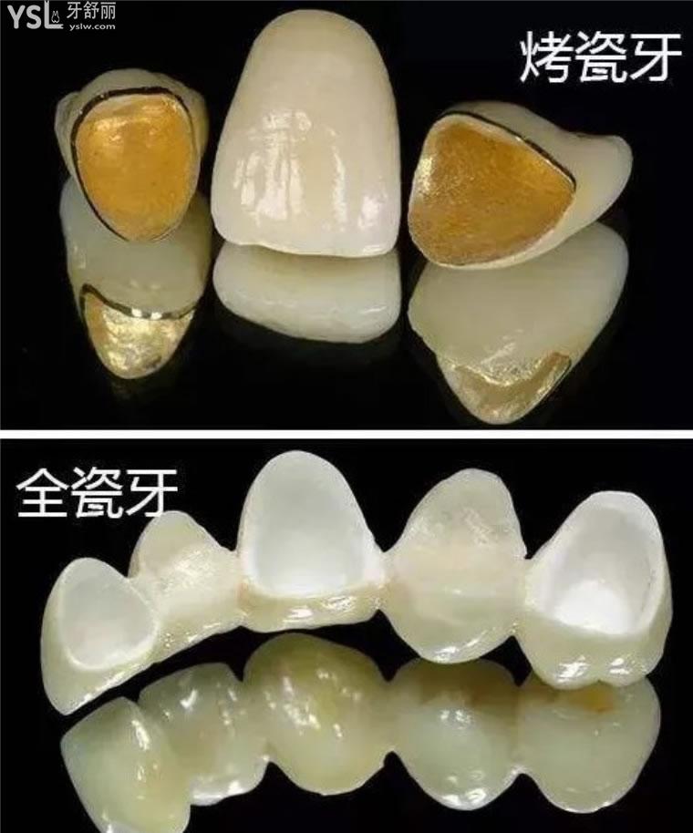 昆明全瓷牙套多少錢一顆價格表