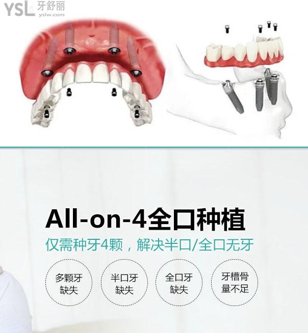 all-on-4半口全口種植圖