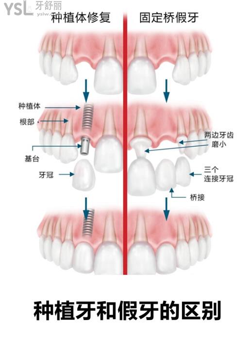 種植牙和假牙的區(qū)別