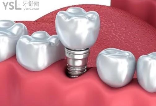 佛山種植牙收費(fèi)標(biāo)準(zhǔn)全口半口種牙費(fèi)用貴嗎