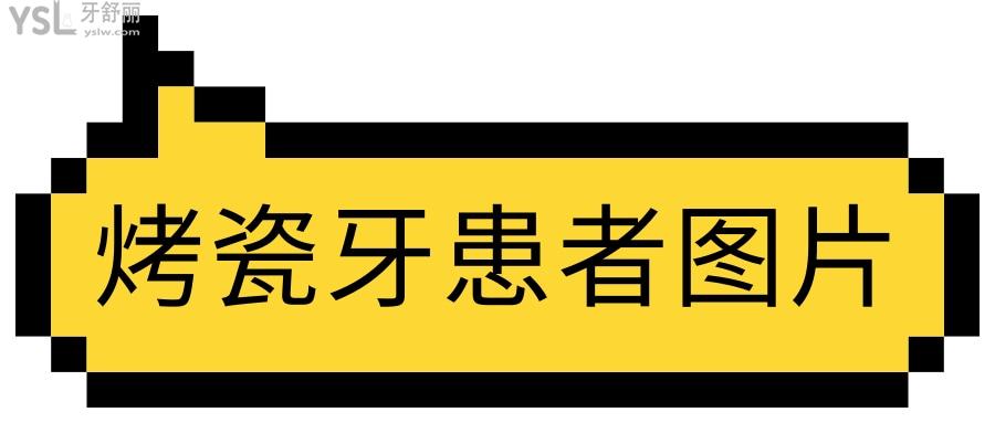 烤瓷牙患者圖片