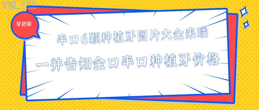 半口6顆種植牙圖片大全，全口半口種植牙價格