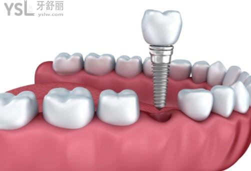 廈門登特口腔拔牙補(bǔ)牙多少錢