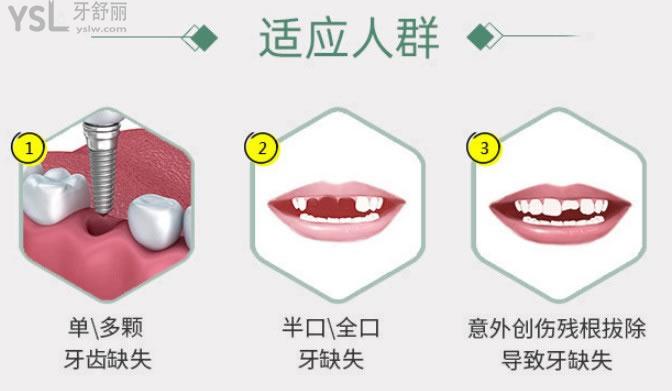 種植牙適應(yīng)人群