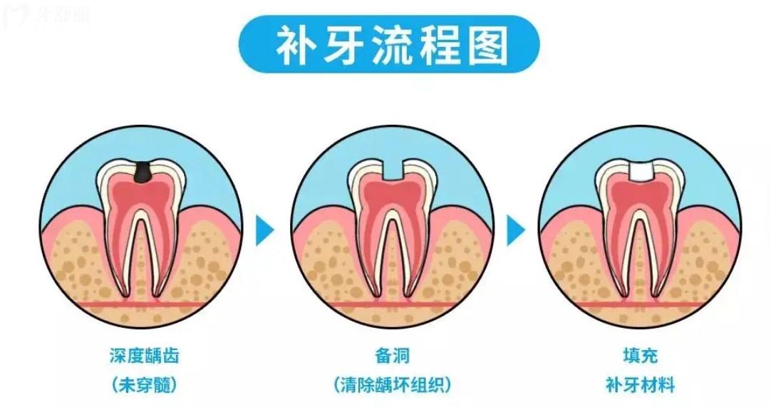 補牙流程圖