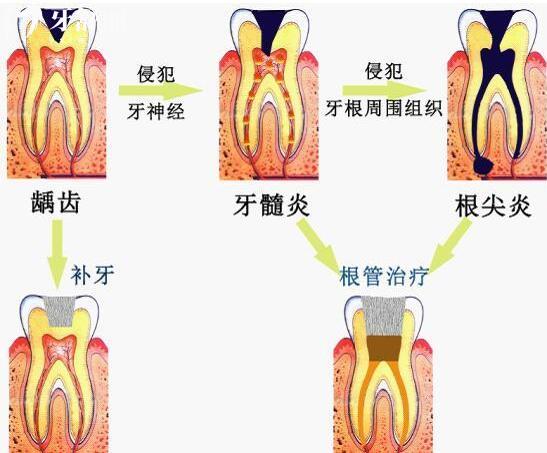 為什么牙醫(yī)都推薦做根管治療？牙疼就一定要做嗎？