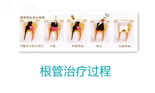 為什么牙醫(yī)都推薦做根管治療？牙疼就一定要做嗎？