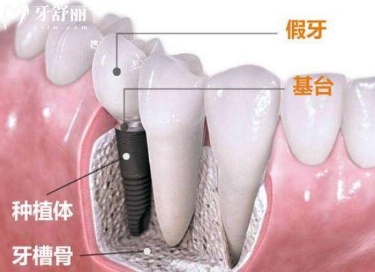 種牙