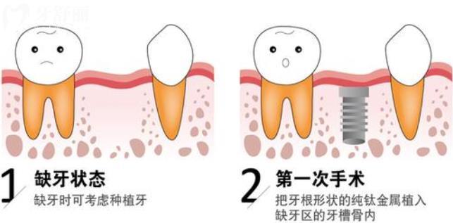 種牙