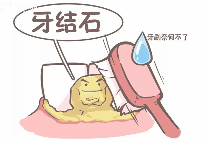 牙結石