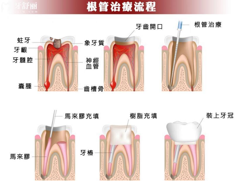 牙疼了一夜半邊臉都疼怎么回事?告訴你醫(yī)生不會(huì)說(shuō)的根管秘密.jpg
