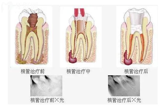 牙疼了一夜半邊臉都疼怎么回事?告訴你醫(yī)生不會(huì)說(shuō)的根管秘密.jpg