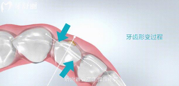 牙套