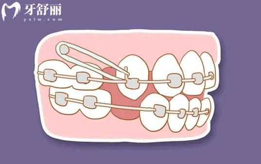牙齒矯正支抗釘