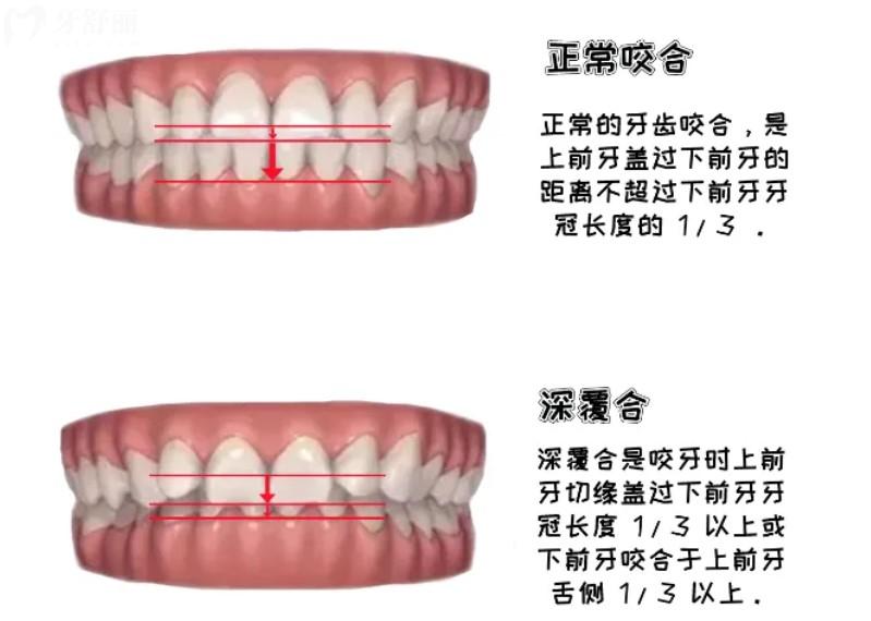 正常咬合和深覆合