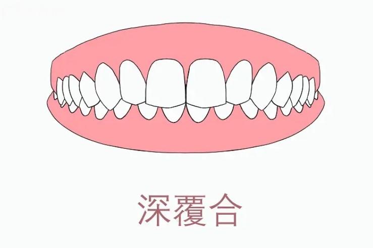 深覆合