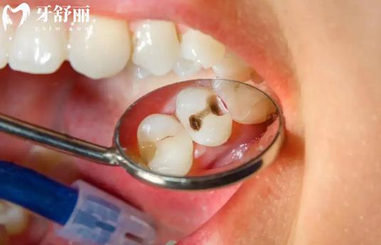 陶瓷材料補(bǔ)牙