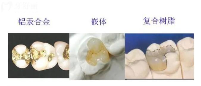 補(bǔ)牙材料