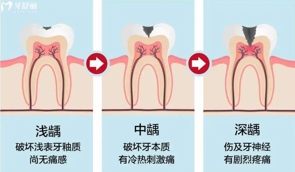 蛀牙的發(fā)展過程