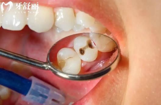 齲齒是怎么形成的