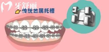 牙齒矯正會(huì)變牙套臉？帶牙套1~12月變化圖