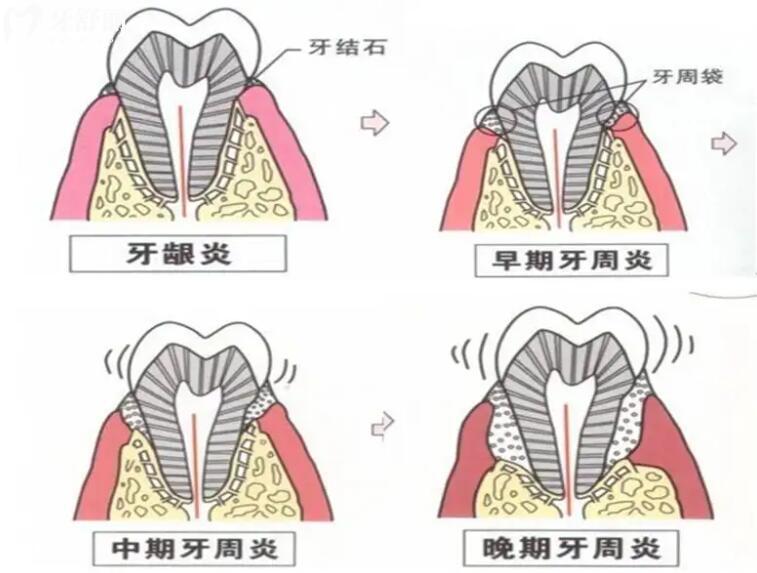 牙周炎能治好嗎？