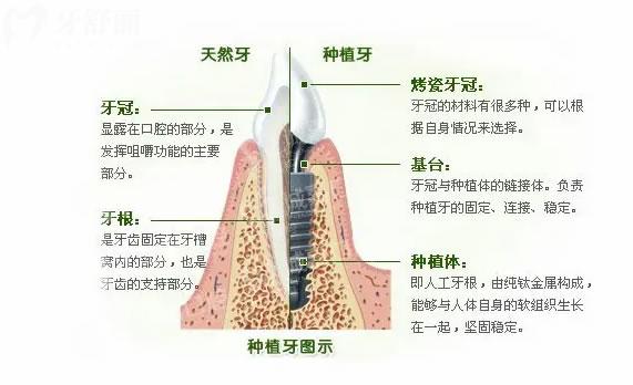 種植牙結(jié)構(gòu)