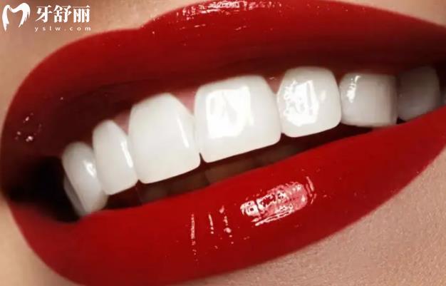 牙齒美白