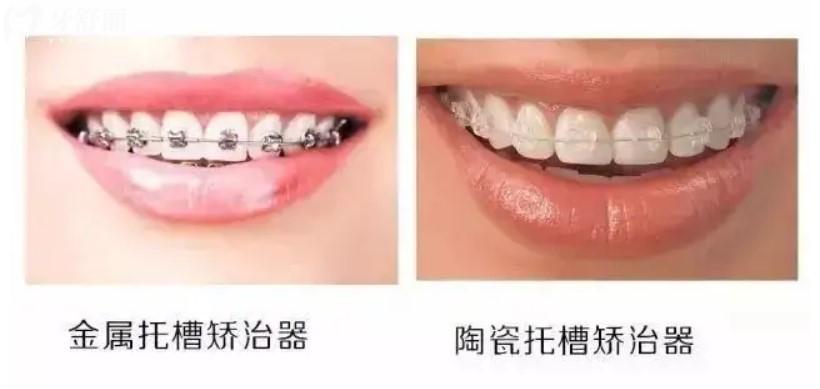 牙齒矯正器