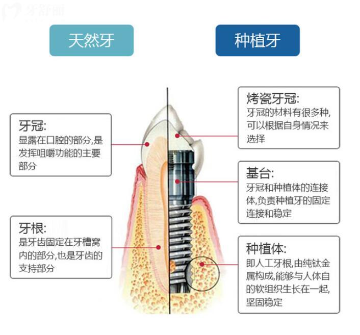重慶種植牙集采價(jià)格是真的實(shí)在降了嗎？可能要打七折
