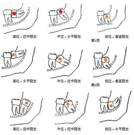 請(qǐng)問智齒一定要拔嗎一定要拔嗎?拔智齒后多久可以正常?.jpg