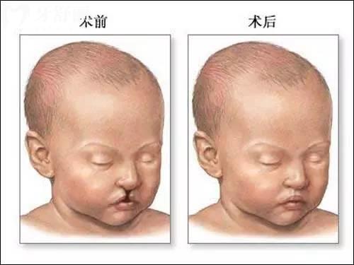 腭裂手術(shù)后什么時(shí)候什么東西都能吃?你不要亂來啊!