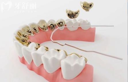 南京玄武醫(yī)院牙齒矯正費(fèi)用公布 金屬隱形牙套一般需要多少錢？
