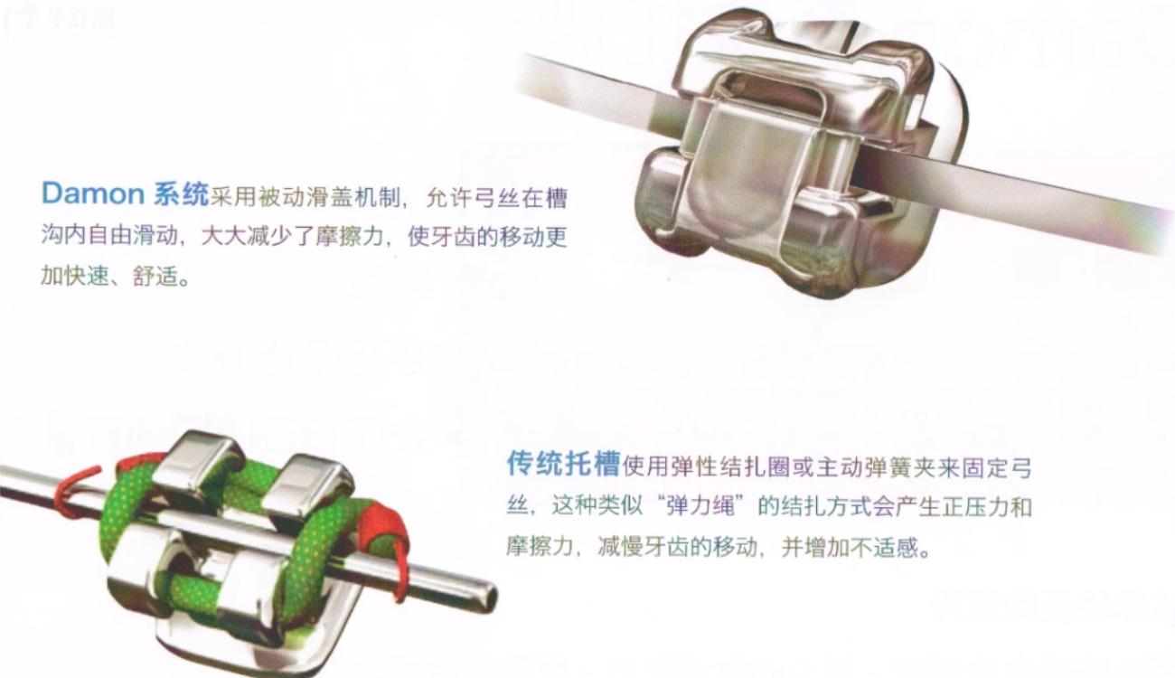 傳統(tǒng)金屬自鎖矯正.jpg
