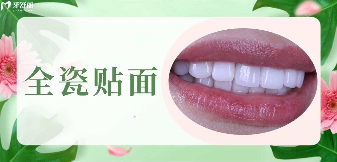 全瓷貼面