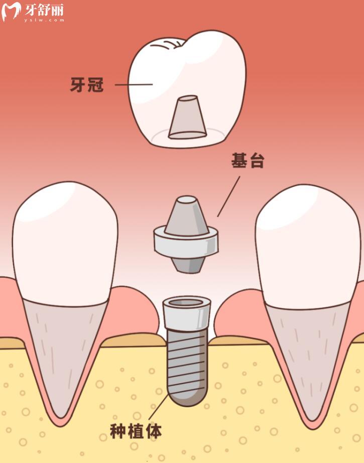 淮安艾可維口腔種植牙怎么樣呀?價格貴嗎?看看親診者怎么說