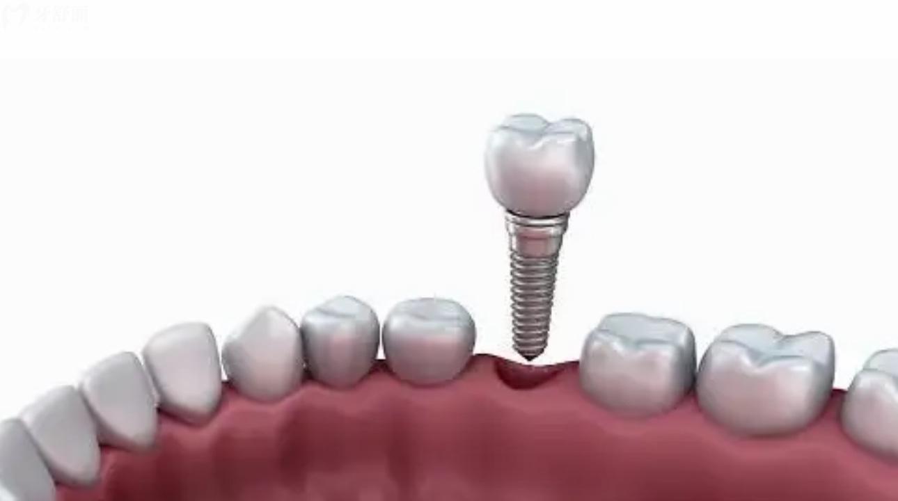 深圳利仁口腔診所怎么樣?深扒口碑發(fā)現(xiàn)有內(nèi)幕