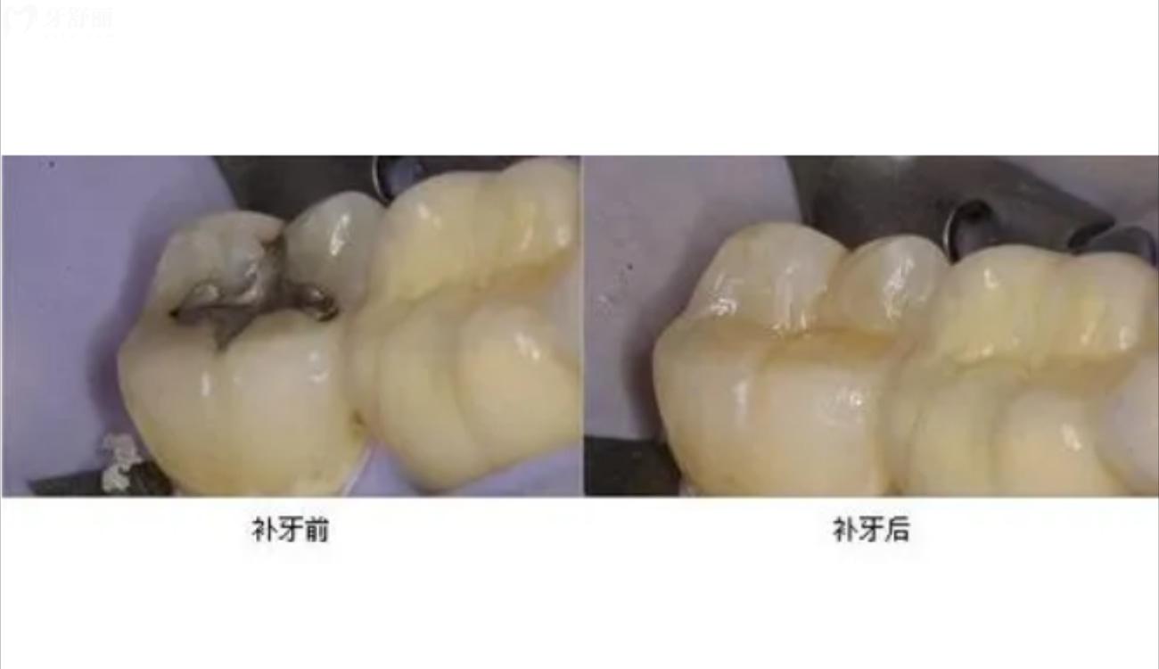 日本松風(fēng)樹脂補(bǔ)牙怎么樣.jpg