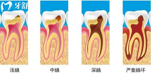 發(fā)起病來難以入眠的牙疼為什么總在深夜開始？