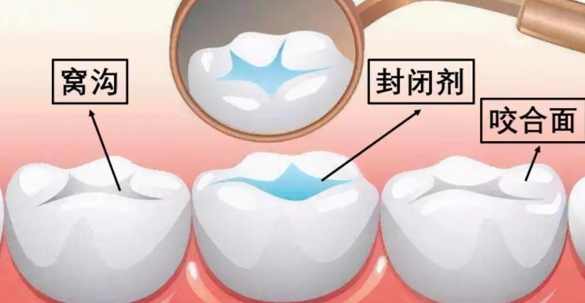 宜賓口腔收費(fèi)標(biāo)準(zhǔn) 宜賓補(bǔ)牙多少錢一顆 宜賓種植牙多少錢一顆 宜賓牙齒矯正怎么收費(fèi)