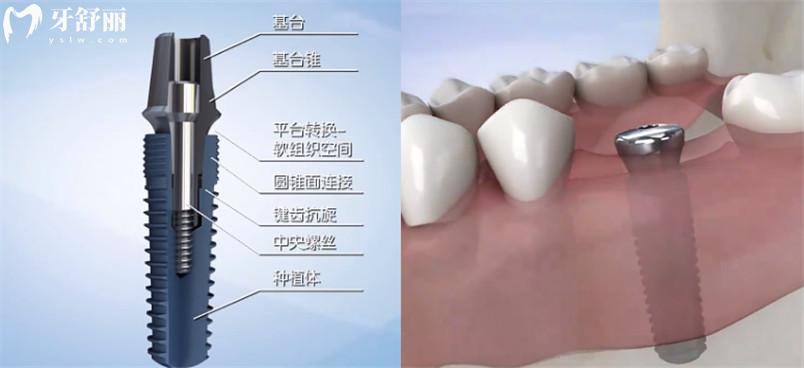 宜賓口腔收費(fèi)標(biāo)準(zhǔn) 宜賓補(bǔ)牙多少錢一顆 宜賓種植牙多少錢一顆 宜賓牙齒矯正怎么收費(fèi)