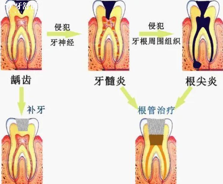 什么是牙髓炎