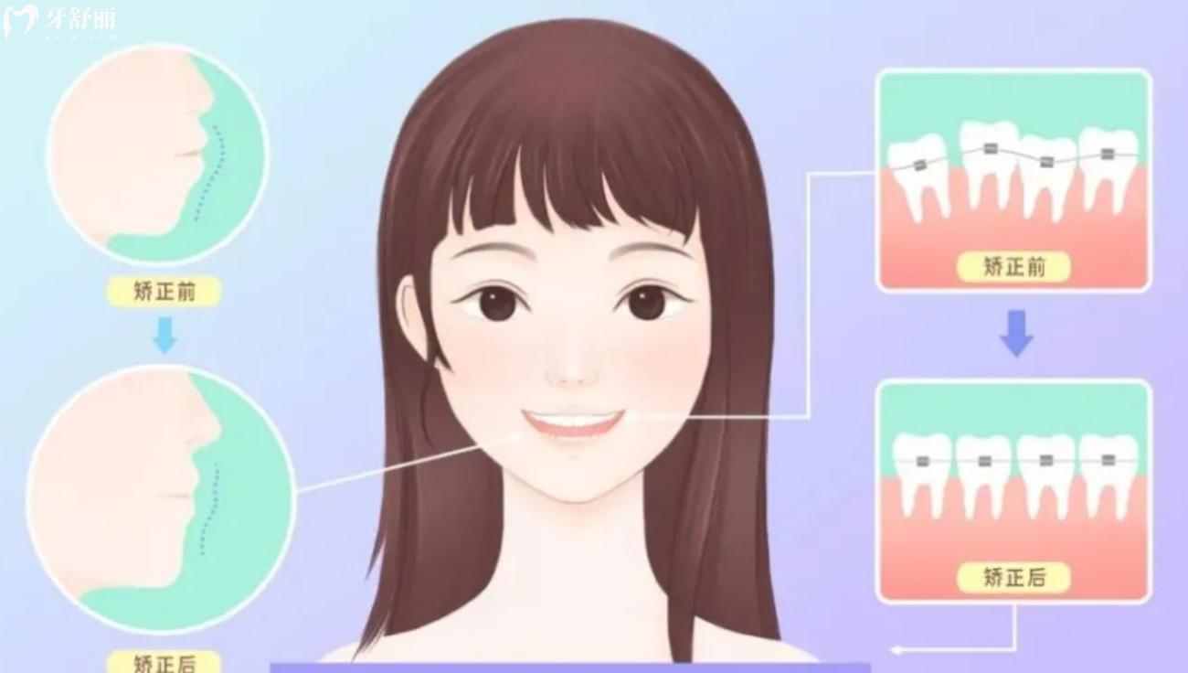 撫順牙齒矯正大概要花費多少錢.jpg