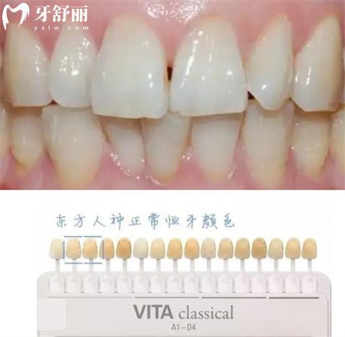 為什么每天認真刷牙牙齒還不會變白？有什么解決辦法？