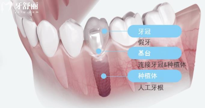 濟(jì)南種植牙多少錢一顆 濟(jì)南牙科23年新版價目表更新 