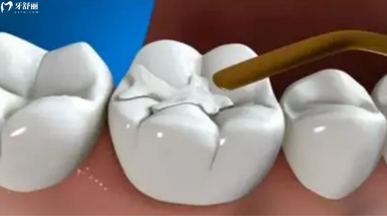 深圳佳茗口腔診所怎么樣?親診種牙矯牙不貴靠譜