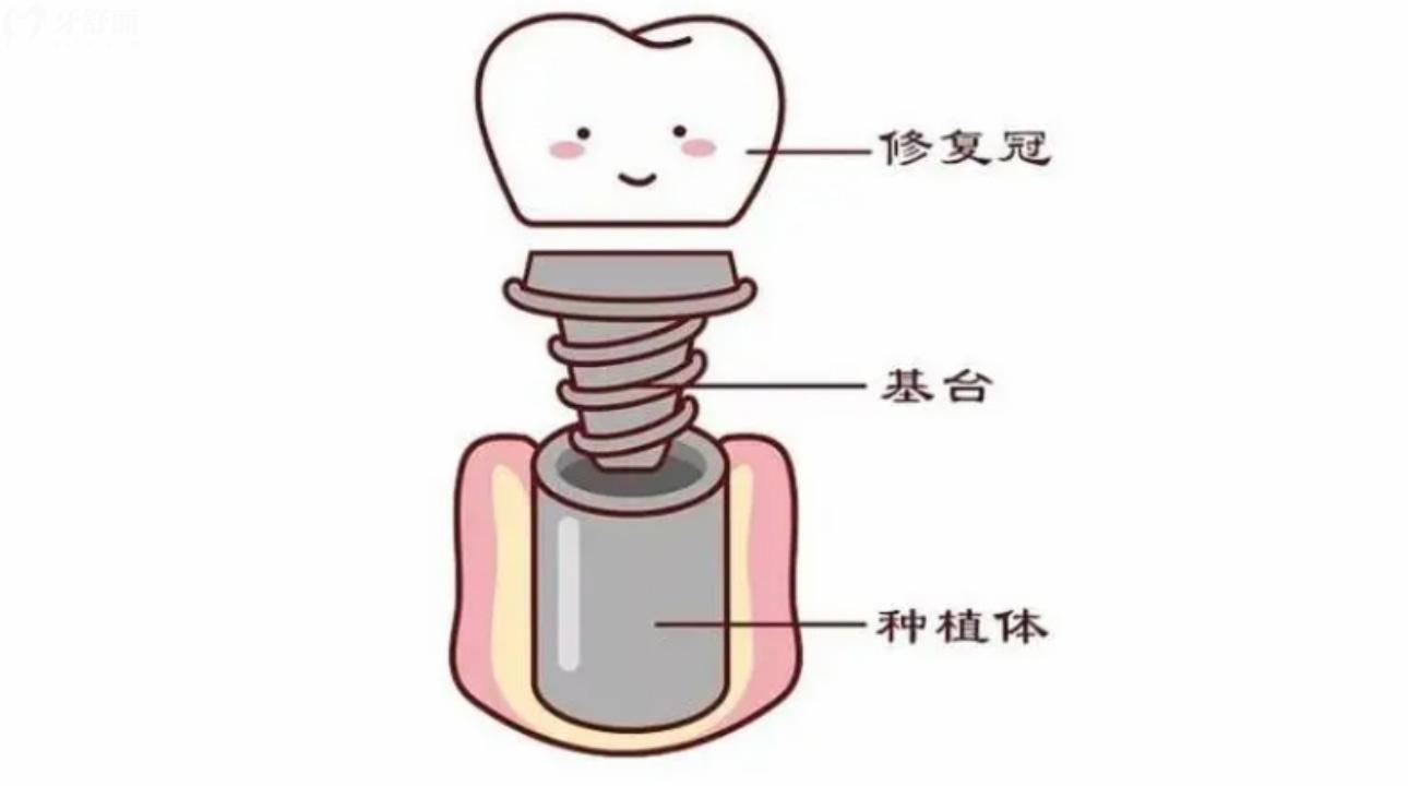 德國貝格Bego種植體