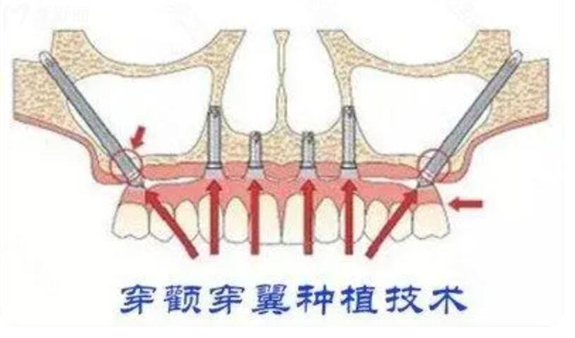 穿顴穿翼種植術(shù)
