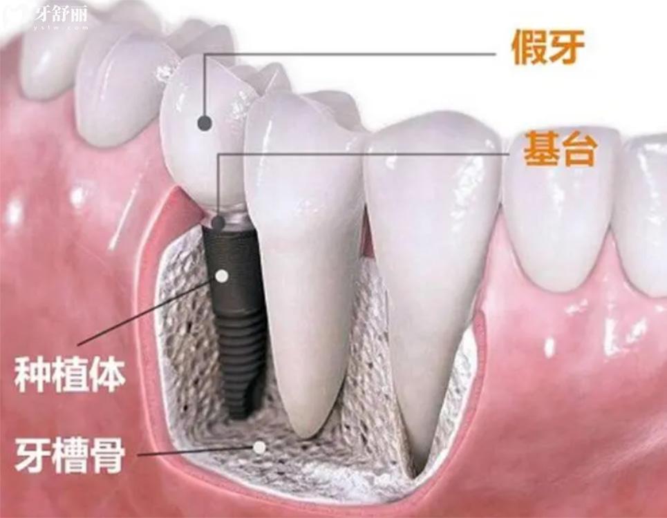 孝感種植牙多少錢(qián)一顆.jpg