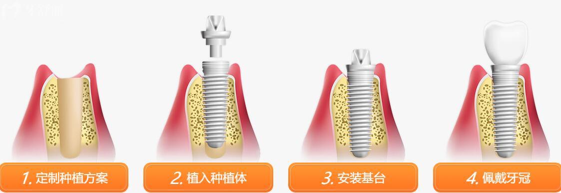 瑞典Nobel諾貝爾種植牙怎么樣